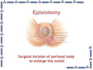 Episiotomy
 