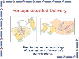 Forceps-assisted Delivery
Used to shorten the second stage
of labor and assist the woman’s
pushing efforts.
 