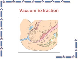 Vacuum Extraction
 