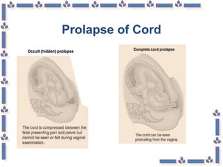 Prolapse of Cord
 
