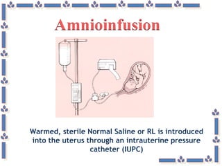 Warmed, sterile Normal Saline or RL is introduced
into the uterus through an intrauterine pressure
catheter (IUPC)
 