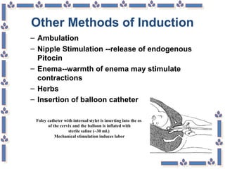 Other Methods of Induction
– Ambulation
– Nipple Stimulation --release of endogenous
Pitocin
– Enema--warmth of enema may stimulate
contractions
– Herbs
– Insertion of balloon catheter
Foley catheter with internal stylet is inserting into the os
of the cervix and the balloon is inflated with
sterile saline (~30 ml.)
Mechanical stimulation induces labor
 