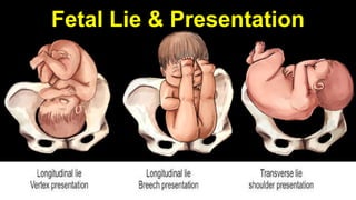 10
Fetal Lie & Presentation
 