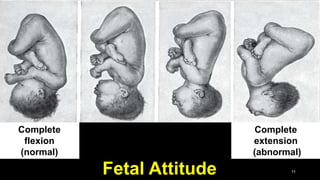Fetal Attitude 11
Complete
extension
(abnormal)
Complete
flexion
(normal)
 