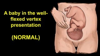 A baby in the well-
flexed vertex
presentation
(NORMAL)
 
