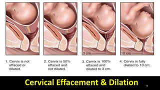 19
Cervical Effacement & Dilation
 
