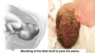28
Moulding of the fetal skull to pass the pelvis.
 