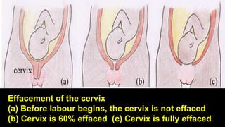 Effacement of the cervix
(a) Before labour begins, the cervix is not effaced
(b) Cervix is 60% effaced (c) Cervix is fully effaced
 