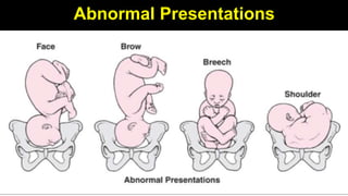Abnormal Presentations
 