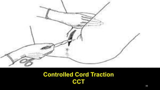 48
Controlled Cord Traction
CCT
 