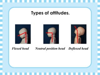 Types of attitudes.
Flexed head Neutral position head Deflexed head
 