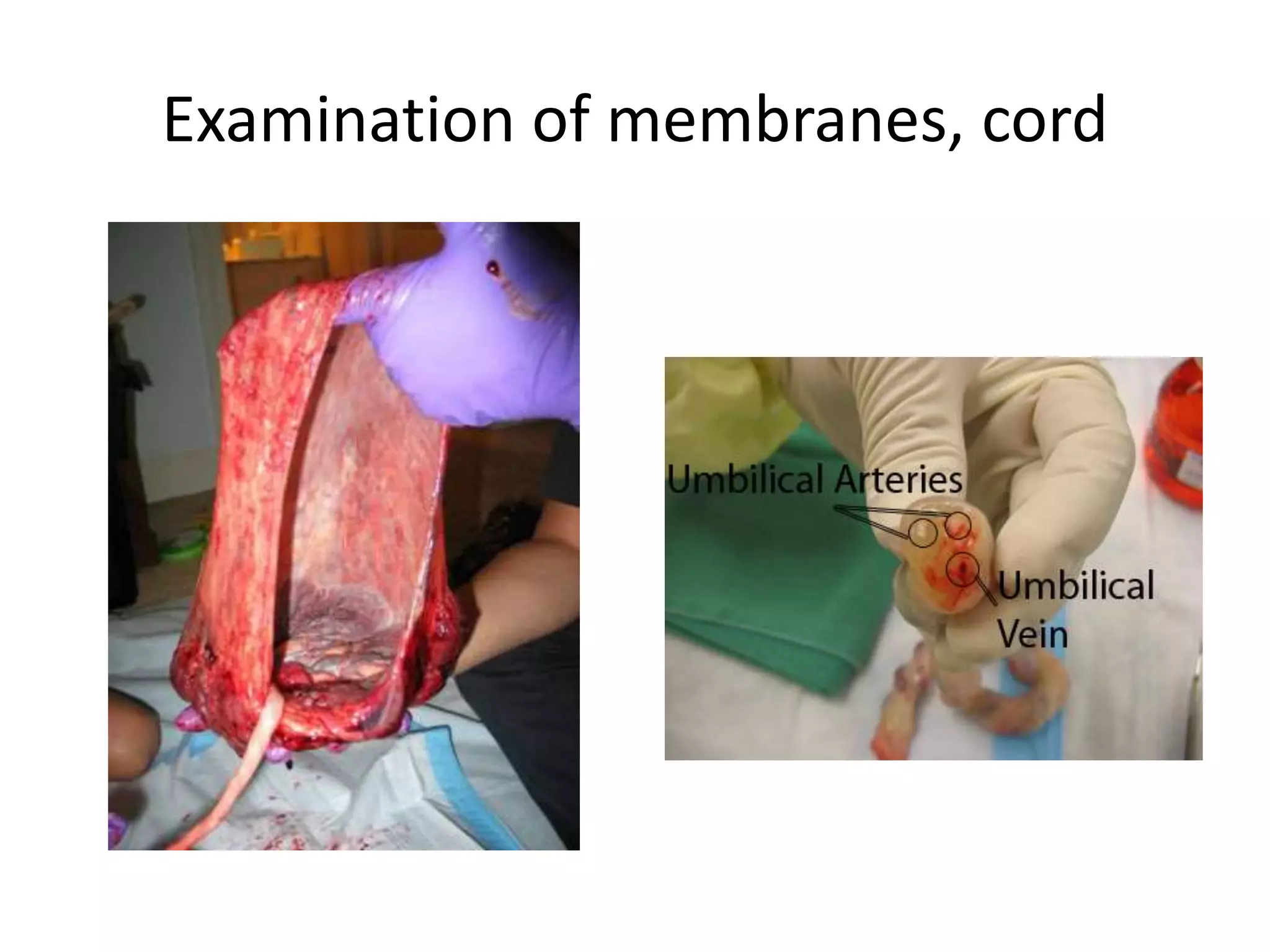 Examination of membranes, cord
 