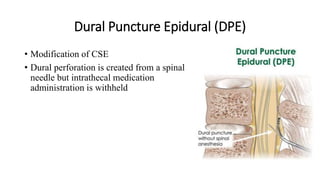 Dural Puncture Epidural (DPE)
• Modification of CSE
• Dural perforation is created from a spinal
needle but intrathecal medication
administration is withheld
 