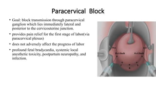 Paracervical Injection laboranalgesia.pptx and its effect on patients | PPTX
