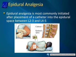 https://www.facebook.com/AnesthesiaTOOLS
Epidural analgesia is most commonly initiated
after placement of a catheter into the epidural
space between L2-3 and L4-5
 