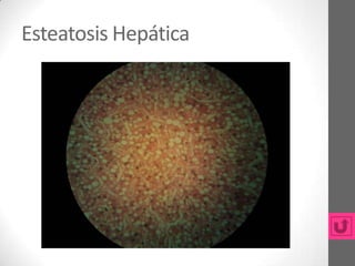 Esteatosis Hepática
 