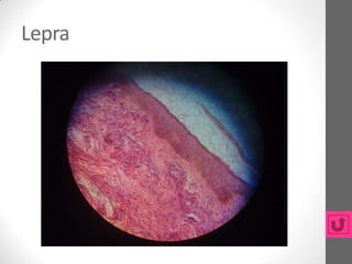 Lepra
 