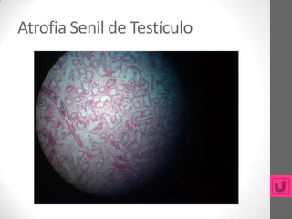 Atrofia Senil de Testículo
 