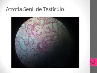 Atrofia Senil de Testículo
 