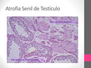 Atrofia Senil de Testículo
 