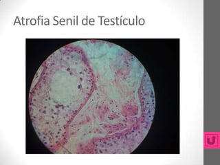 Atrofia Senil de Testículo
 