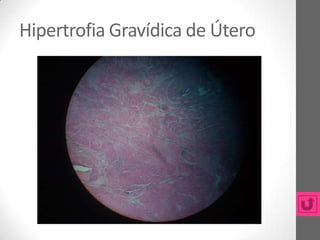 Hipertrofia Gravídica de Útero
 