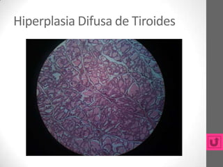 Hiperplasia Difusa de Tiroides
 