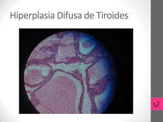 Hiperplasia Difusa de Tiroides
 