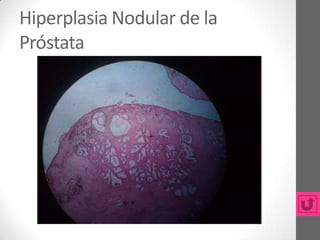 Hiperplasia Nodular de la
Próstata
 