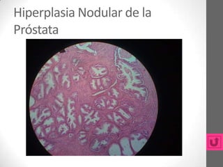 Hiperplasia Nodular de la
Próstata
 