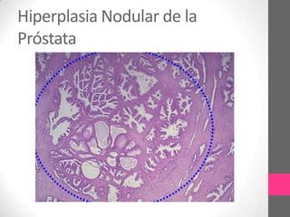 Hiperplasia Nodular de la
Próstata
 