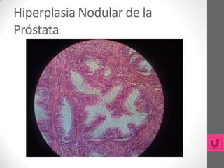 Hiperplasia Nodular de la
Próstata
 