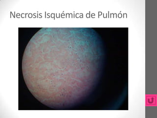 Necrosis Isquémica de Pulmón
 