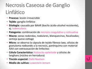 Necrosis Caseosa de Ganglio
Linfático
• Proceso: lesión irreversible
• Tejido: ganglio linfático
• Etiología: causado por BAAR (bacilo ácido-alcohol resistente),
  ej. tuberculosis
• Patogenia: combinación de necrosis coagulativa y colicuativa
• Macro: zonas redondas, nodulares, blanquecinas, focalizadas;
  semeja queso cottage
• Micro: se observa la cápsula de tejido fibroso laxo, células de
  granuloma rodeando a la necrosis, parénquima con material
  AAA con extravasación de linfocitos
• Célula Característica: histiocito epiteloide y células de
  langhans (núcleo en herradura)
• Tinción especial: Ziehl-Neelsen
• Medio de cultivo: Lowestein-Jensen
 
