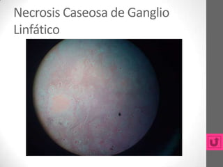 Necrosis Caseosa de Ganglio
Linfático
 