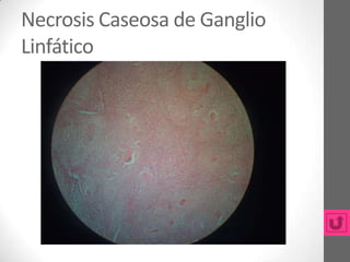 Necrosis Caseosa de Ganglio
Linfático
 