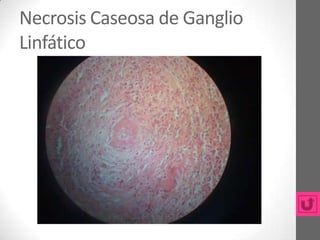 Necrosis Caseosa de Ganglio
Linfático
 