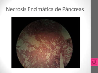 Necrosis Enzimática de Páncreas
 
