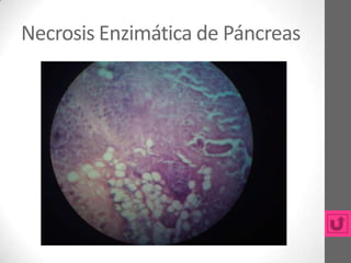 Necrosis Enzimática de Páncreas
 