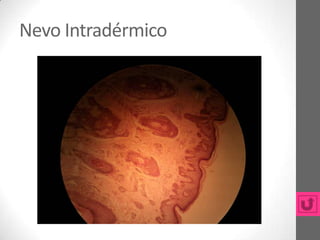 Nevo Intradérmico
 