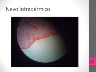 Nevo Intradérmico
 