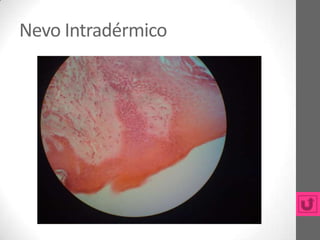 Nevo Intradérmico
 