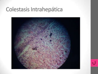 Colestasis Intrahepática
 