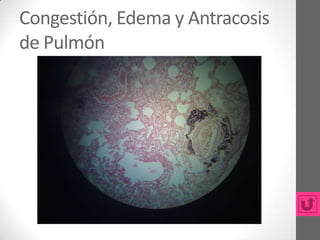 Congestión, Edema y Antracosis
de Pulmón
 