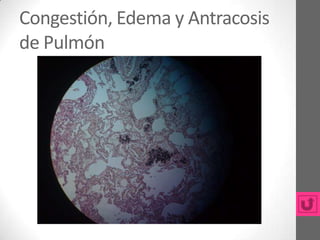 Congestión, Edema y Antracosis
de Pulmón
 