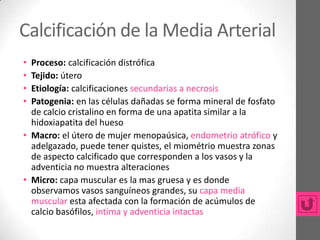 Calcificación de la Media Arterial
• Proceso: calcificación distrófica
• Tejido: útero
• Etiología: calcificaciones secundarias a necrosis
• Patogenia: en las células dañadas se forma mineral de fosfato
  de calcio cristalino en forma de una apatita similar a la
  hidoxiapatita del hueso
• Macro: el útero de mujer menopaúsica, endometrio atrófico y
  adelgazado, puede tener quistes, el miométrio muestra zonas
  de aspecto calcificado que corresponden a los vasos y la
  adventicia no muestra alteraciones
• Micro: capa muscular es la mas gruesa y es donde
  observamos vasos sanguíneos grandes, su capa media
  muscular esta afectada con la formación de acúmulos de
  calcio basófilos, intima y adventicia intactas
 
