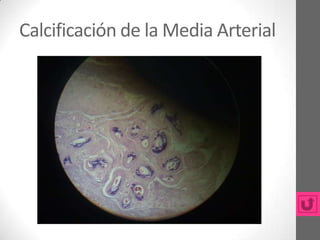Calcificación de la Media Arterial
 