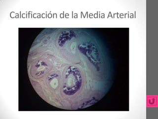 Calcificación de la Media Arterial
 