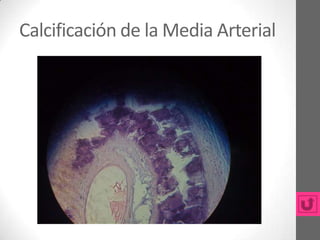 Calcificación de la Media Arterial
 