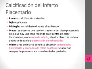 Calcificación del Infarto
Placentario
• Proceso: calcificación distrofica
• Tejido: placenta
• Etiología: microinfarto durante el embarazo
• Macro: se observa una sección trasversa del disco placentario
  en la que hay una zona redonda en el centro de color
  blanquecino, a una zona de infarto, el color blanco se debe al
  deposito de calcio y destrucción de vellosidades
• Micro: área de infarto donde se observan vellosidades
  hialinizadas y acúmulos de calcio basófilos, se aprecian
  cuerpos de psamoma en las vellosidades terciarias
 